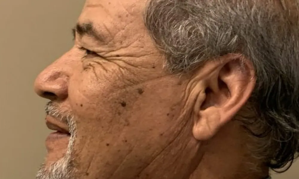 Clinical photo from Isidro's jaw tumor removal and reconstruction case